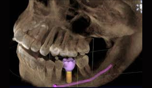 Tomografia 3D