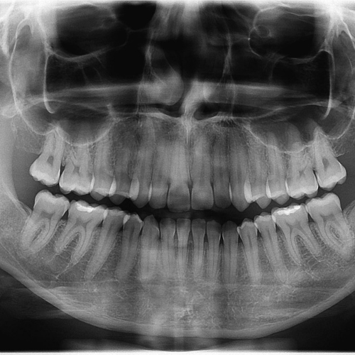 Intrabucal