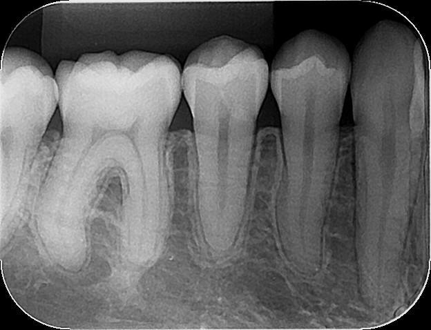 Radiografia Intrabucal
